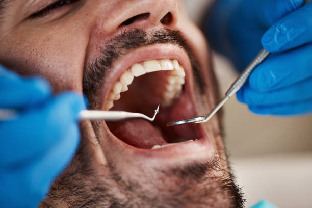 Best Emergency Wisdom Teeth Removal in Ninnekah, OK